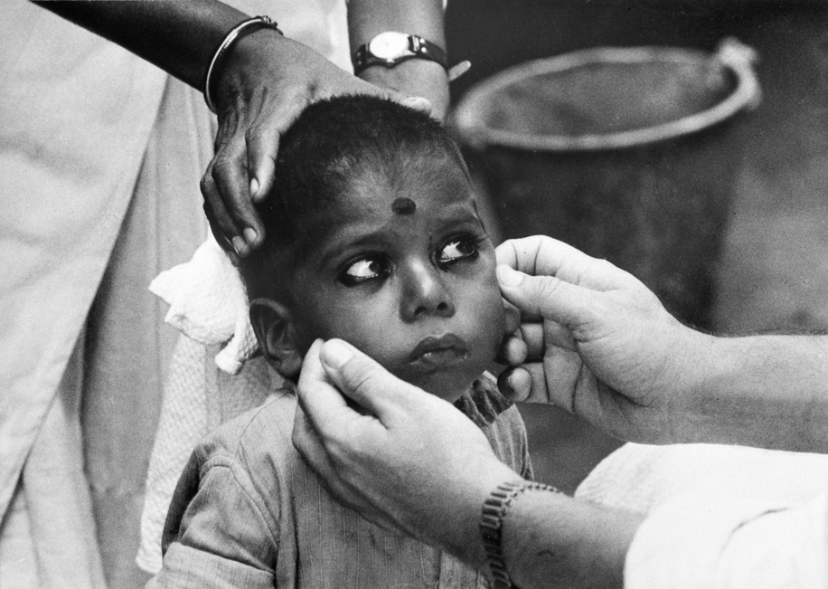 Eyes that need weep no more. In 1959 it was estimated that nearly 400 million people suffered from trachoma. Though this eye infection does not kill, it can last a lifetime if untreated. Its victims often become blind. In India, trachoma was the largest single cause of preventable blindness. In some rural areas of Northern India the infection rate was as high as 80-90 per cent of the total population. A WHO-assisted pilot project trachoma team based at the Gandhi Eye Hospital in Aligarh, Uttar Pradesh, visited the region village by village, examining patients and organizing antibiotic treatment, and carrying out research to determinate the ways in which infection spread. The methods of attack proved effective in preventing blindness but complete control of trachoma and associated bacterial conjunctivitis requires the support of long-term health education and environmental sanitation programmes. The manner of applying eye cosmetics (