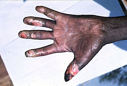 The hands of a leprosy patient which have been severely burnt as a result of profound loss of sensation.