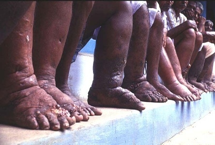 The disfigured legs of patients waiting for medical attention at the Vector Control Research Centre (VCRC).