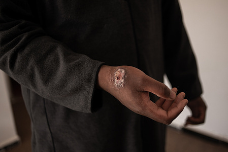17 March 2021. A patient with leishmaniasis is treated at the National Centre for Disease Control in Tawergha, Libya. Cutaneous leishmaniasis is a major public health problem in Libya. The disease causes skin lesions, mainly ulcers, on exposed parts of the body. Without proper treatment, it can leave life-long scars and lead to serious disability or stigma. WHO is the sole provider of antileishmanial treatments in Libya. In addition to providing medicines, WHO has helped to train health workers in Tawergha on treating patients with leishmaniasis.